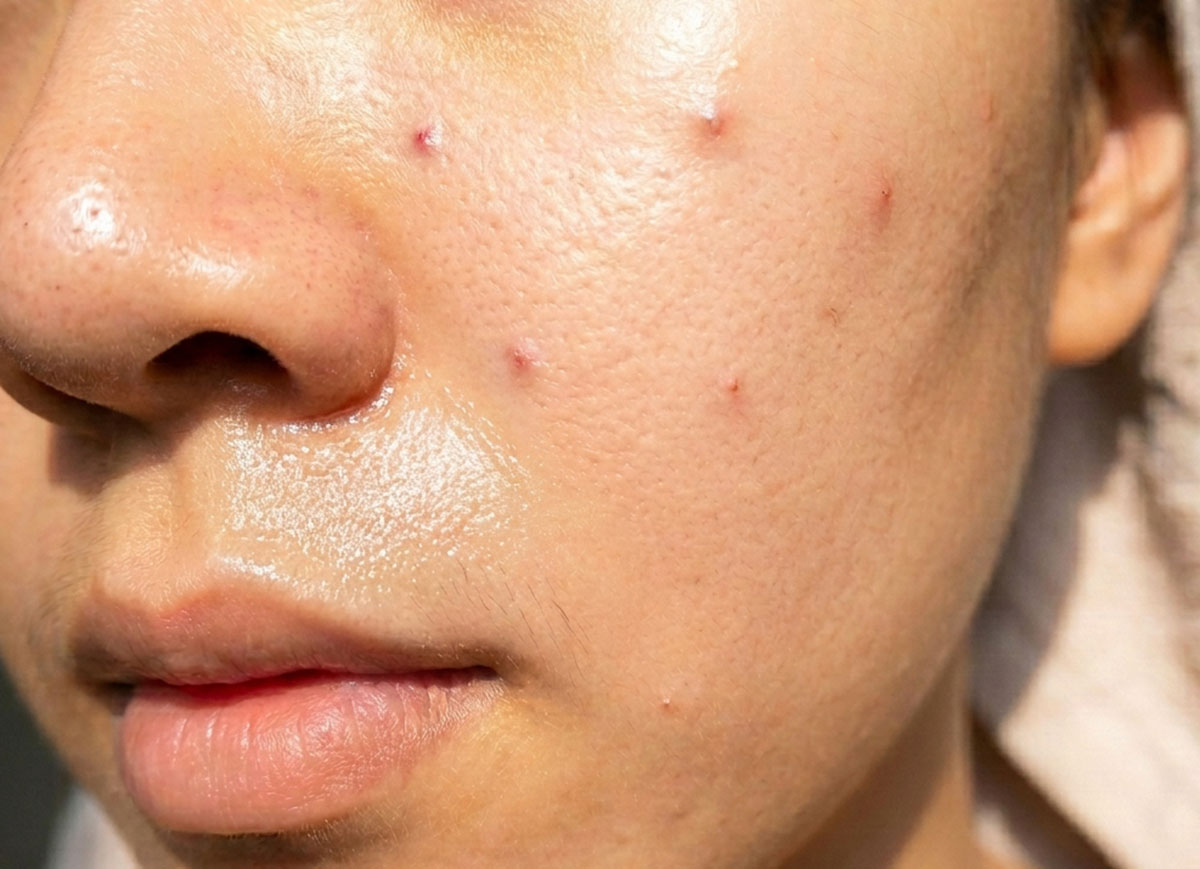 Biểu hiện mụn trên da 